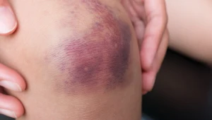 Nie znikały jej siniaki, trafiła do szpitala. Diagnoza była szokiem