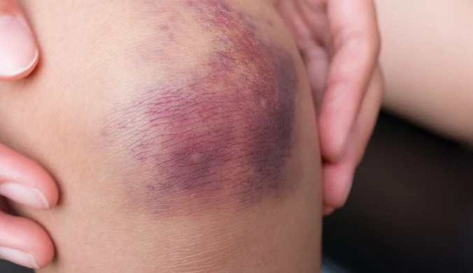 Kobieta zgłosiła się z utrzymującymi się siniakami i bólem. Z czasem jej stan się pogorszył. Diagnoza zaskoczyła wszystkich.
