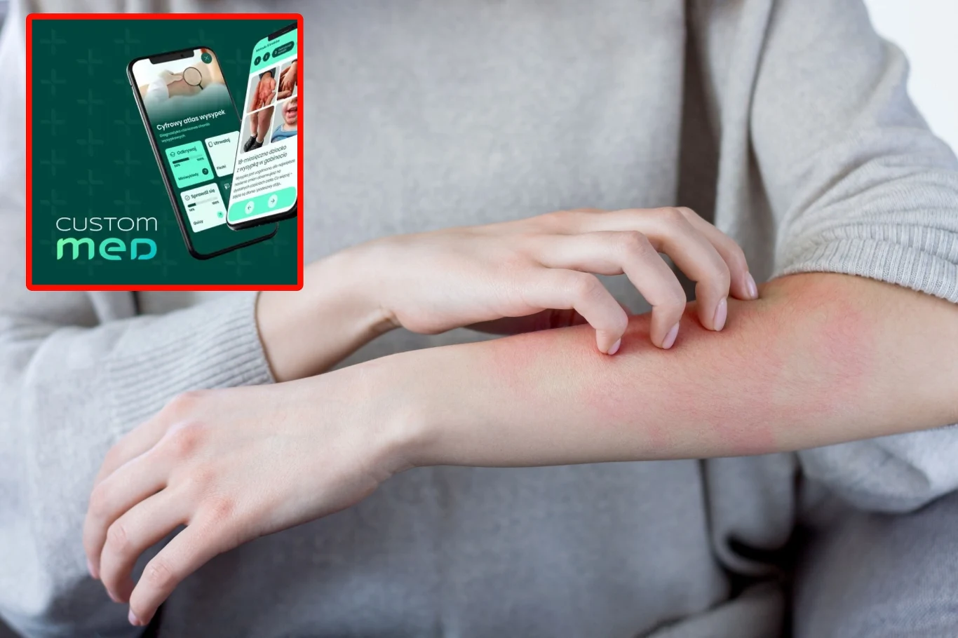Jaka to wysypka i czy jest groźna? Cyfrowy Atlas Wysypek na telefonie pomoże to ustalić Osoba drapiąca czerwoną, podrażnioną skórę na przedramieniu, w lewym górnym rogu wizualizacja aplikacji medycznej Custom Med na smartfonie.