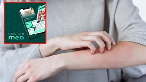 Co to za wysypka? Polscy naukowcy stworzyli wyjątkową aplikację