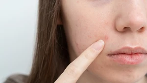 Domowa mikstura na pryszcze i zaskórniki. Wystarczy wymieszać składniki z kuchni