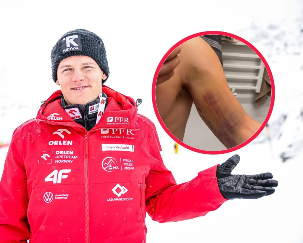 Piotr Habdas. W ramce ręka Polaka po upadku Piotr Habdas. W ramce ręka Polaka po upadku