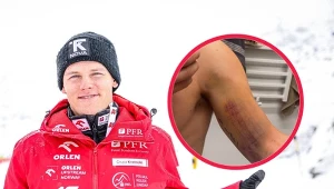 Poważna kontuzja Polaka. Pokazał zdjęcia, zaraz czeka go operacja