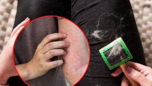 Objawy alergii w dużej mierze zależą od rodzaju alergenu!