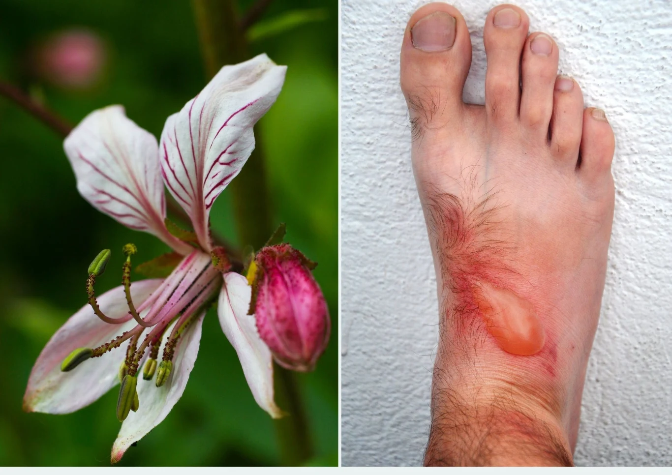 Krzew Mojżesza może powodować oparzenia, bo wyjątkowo uwrażliwia tkanki na działanie promieni słonecznych