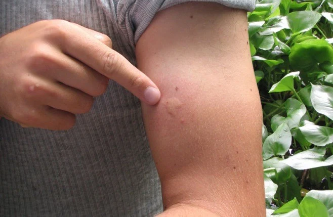 Meszki nie są groźne dla ludzi, choć ich ukąszenia bywają bolesne