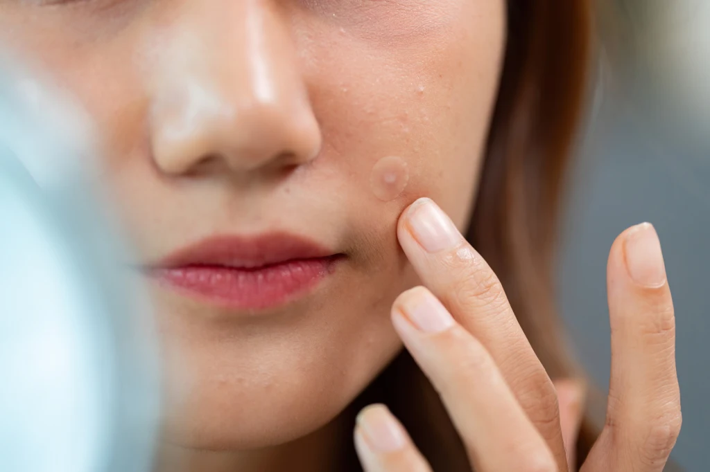 Plaster punktowy. Szybkie wsparcie dla cery w kryzysie? 