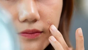 Zanim nakleisz na pryszcza, sprawdź. Nie wszystkie zadziałają idealnie