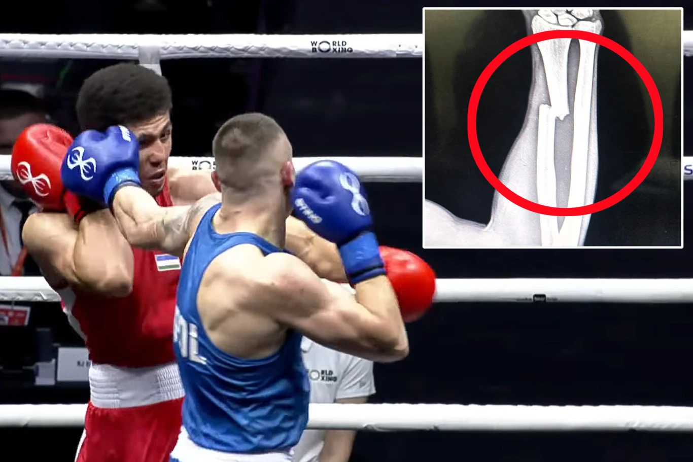 Michał Jarliński końvcył finałową walkę w Indiach ze złamaną ręką Dwóch bokserów podczas walki, jeden w niebieskim stroju zadaje cios przeciwnikowi w czerwonym stroju. W prawym górnym rogu widoczne powiększenie zdjęcia rentgenowskiego ze złamaniem kości, zaznaczonym czerwonym okręgiem.