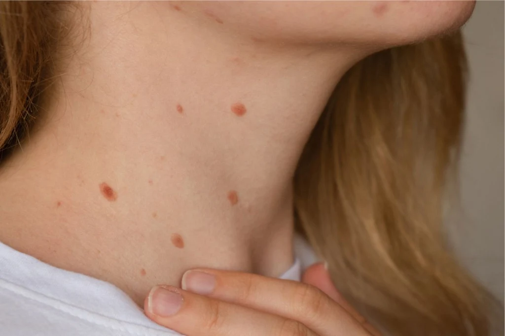 Szyja i fragment twarzy młodej kobiety z widocznymi licznymi pieprzykami oraz ręką delikatnie dotykającą okolicę szyi.