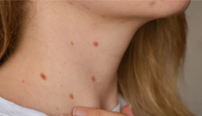 Niepozorne zmiany skórne zwiastują chorobę. Mnożą się przy wysokiej glikemii