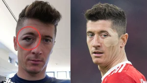 Tak wyglądało oko Lewandowskiego. O tym huczał cały świat. Zdjęcie dowodem