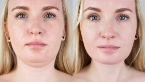 Jak naturalnie zmniejszyć podwójny podbródek?