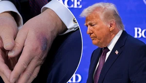 Niepokojący wygląd dłoni Trumpa. Biały Dom reaguje, jest oświadczenie