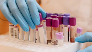 Zrobiony przed badaniem może wpłynąć na wyniki. Wrażliwy zwłaszcza cukier i hormony