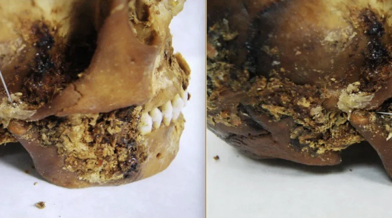 Kultura Pazyryk zadziwia naukowców. Mumia ujawnia ślady starożytnej operacji żuchwy Częściowo zniszczona ludzka czaszka ze szczegółowo widocznymi fragmentami kości oraz szczęką z zachowanymi zębami, na powierzchni obecne ślady rozkładu i resztki organiczne.