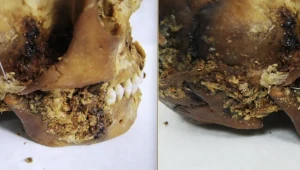 Kultura Pazyryk zadziwia naukowców. Mumia ujawnia ślady starożytnej operacji żuchwy