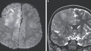 Tak wygląda mózg zniszczony przez odrę. A wystarczyło szczepienie