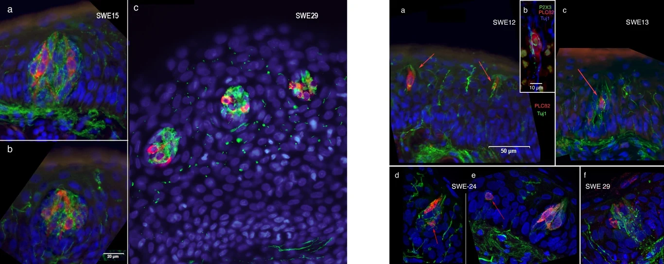 Obraz prezentuje mikroskopowe przekroje tkanki z licznymi komórkami barwionymi na różne kolory: jądra komórkowe na niebiesko, konkretne struktury komórkowe lub białka na zielono i czerwono, z wyraźnie zaznaczonymi skupiskami komórek oraz sygnalizacją w...