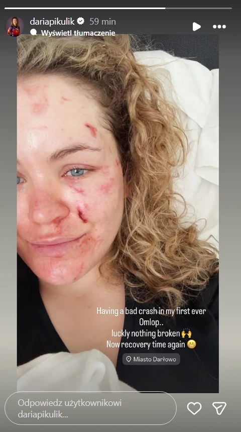 Młoda kobieta z kręconymi włosami z widocznymi zadrapaniami i siniakami na twarzy leży na łóżku, uśmiecha się lekko, w tle poduszka i fragment pościeli.