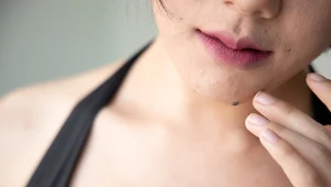 Masz wypukłe znamię? Oceń je według reguły ABCDE i sprawdź, czy jest zdrowe