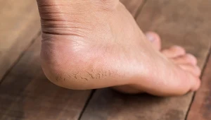 Kup w aptece i nałóż na pięty. Będą gładkie całą wiosnę 