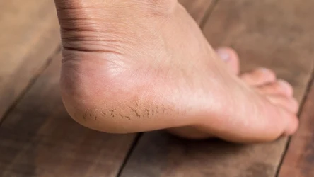 Co stosować na suche i popękane pięty?