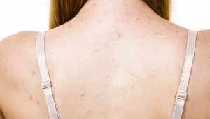 Problemy skórne na plecach, Jak się ich pozbyć?