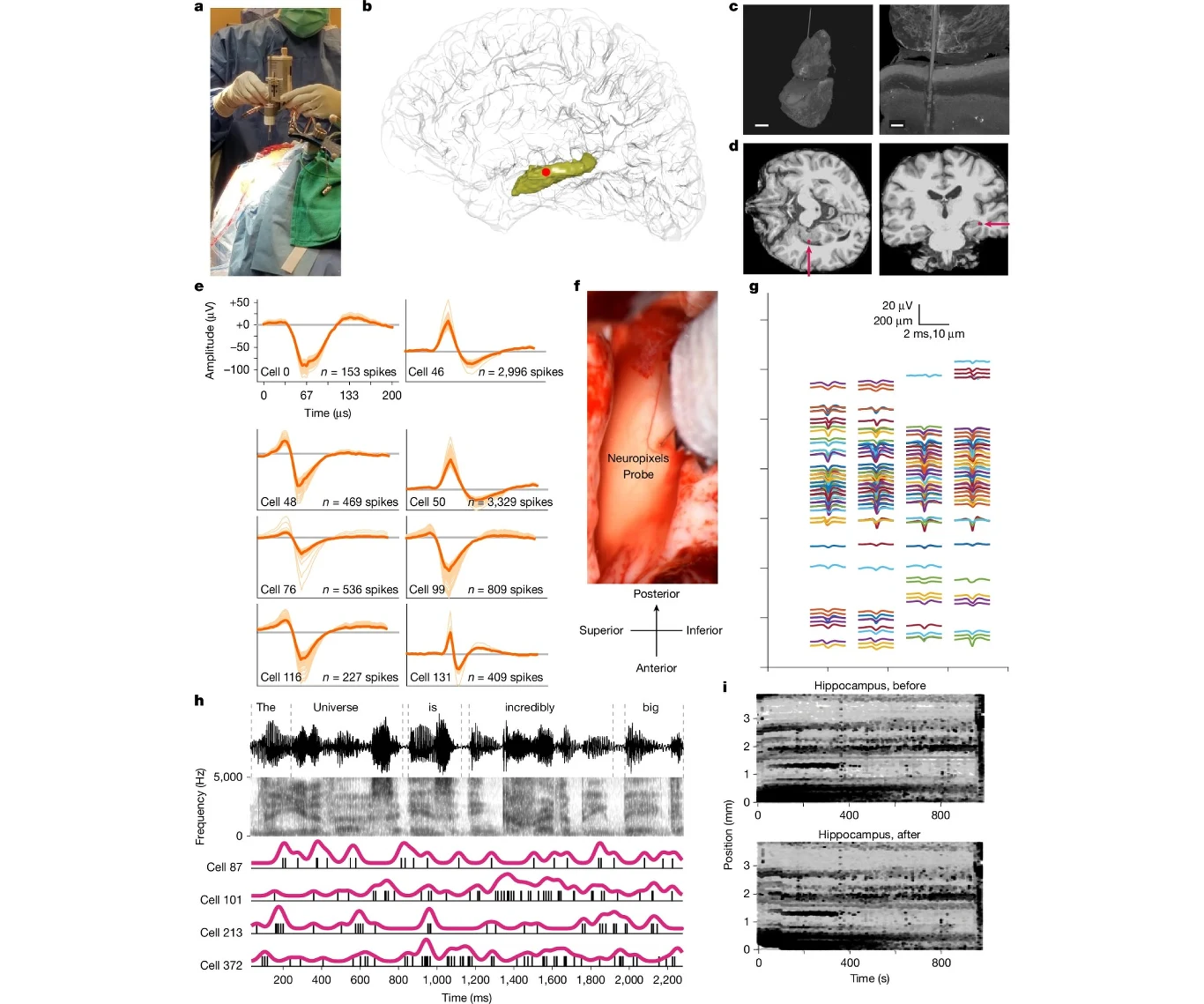 Naukowcy wszczepili sondy Neuropixel do mózgu. Hipokamp wyraźnie rejestrował wypowiadane słowa Zespół medyczny przeprowadzający operację mózgu, ilustracja lokalizacji struktur wewnątrz mózgu, obrazy rezonansu magnetycznego, wykresy aktywności neuronalnej oraz szczegółowe wyniki nagrań i analiz sygnałów mózgowych związanych z eksperymentem neurob...
