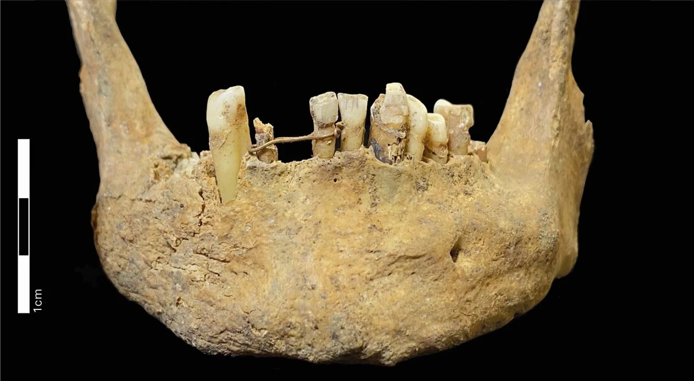 W szczęce mężczyzny zmarłego między 1460 a 1670 rokiem w Aberdeen archeolodzy odkryli ligaturę z 20-karatowego złota