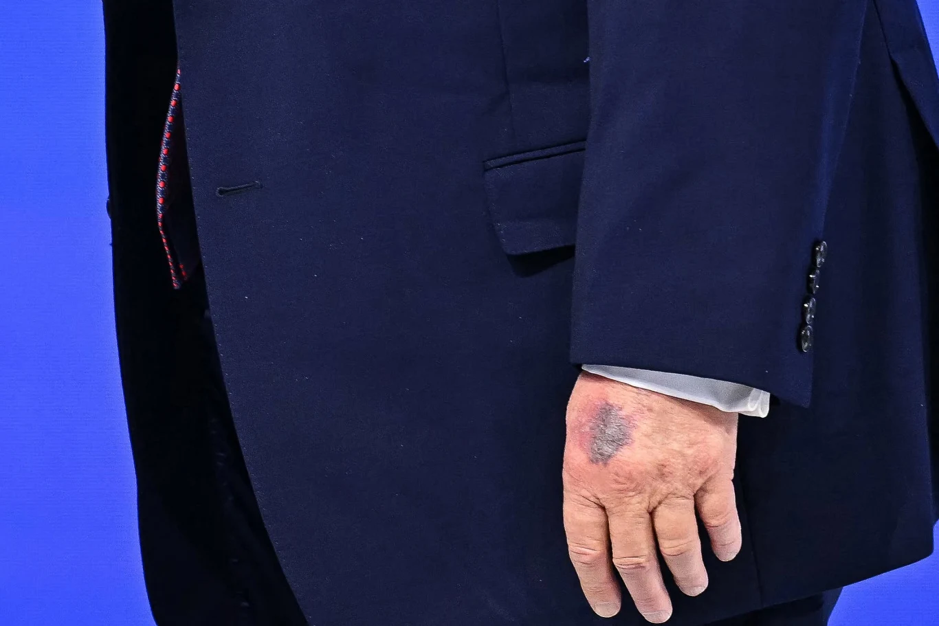 Męska dłoń z dużym siniakiem na grzbiecie, ubrana w granatowy garnitur z widocznym mankietem koszuli.