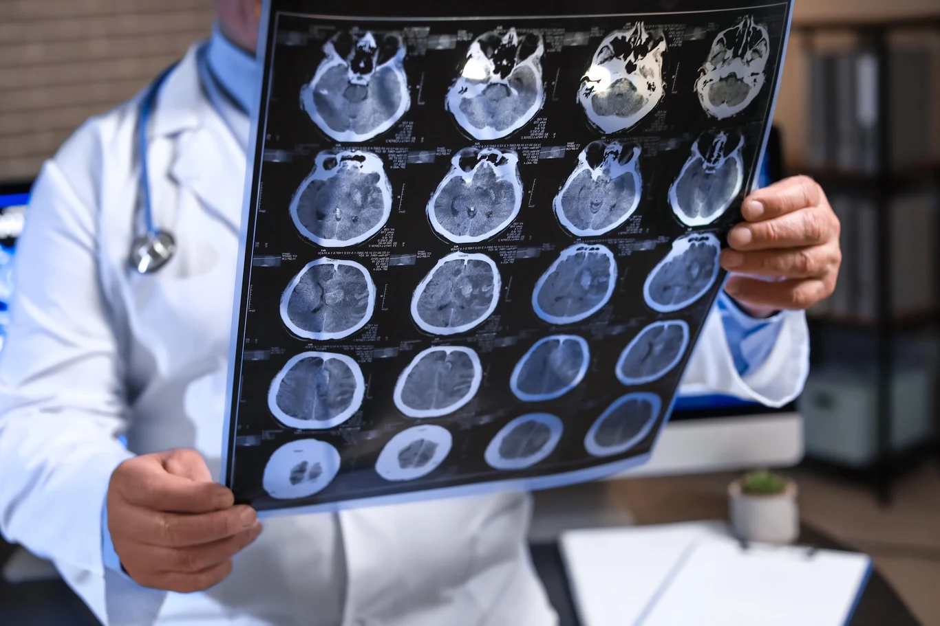Lekarz w białym fartuchu trzyma zdjęcia tomografii komputerowej głowy, na których widoczne są szczegółowe przekroje mózgu w różnych płaszczyznach.