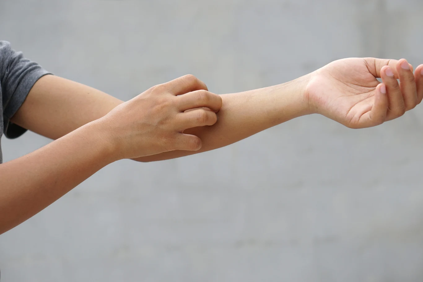 Jednym z objawów pokrzywki jest intensywne swędzenie skóry Zdjęcie rąk; ukazuje osobę, która się drapie, bo ma dolegliwości skórne. Ręce nie są zaczerwienione.