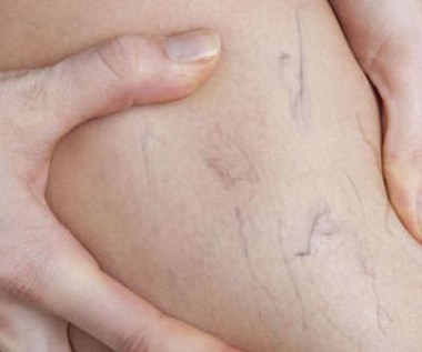 10 domowych sposobów na pajączki
