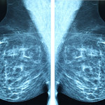 11 dni wystarczy, by pokonać raka piersi