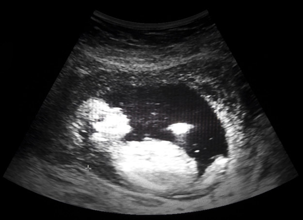 13 tydzień ciąży - zdjęcie USG. /123RF/PICSEL