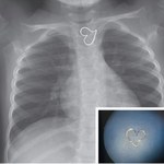 3-latka połknęła wisiorek w kształcie serca
