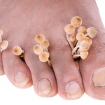 3 naturalne sposoby jak zapobiegać grzybicy stóp