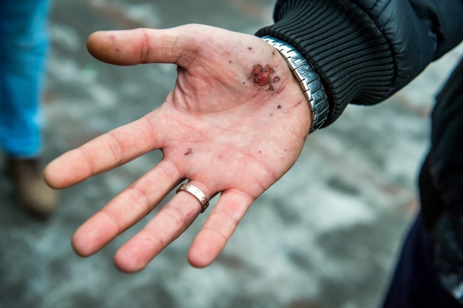 43-letni kierowca otrzymał kilka ciosów kijem baseballowym. Ma także ranę na nodze - od noża bądź kastetu zakończonego ostrym szpikulcem i na ręce /Tytus Żmijewski /PAP