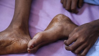 45 mln osób na świecie jest na skraju głodu. To 3 mln więcej niż rok temu