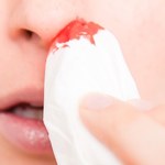 5 domowych sposobów na krwawienie z nosa