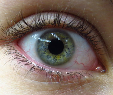 7 nieprawidłowości okolic oka, które mogą być objawem choroby