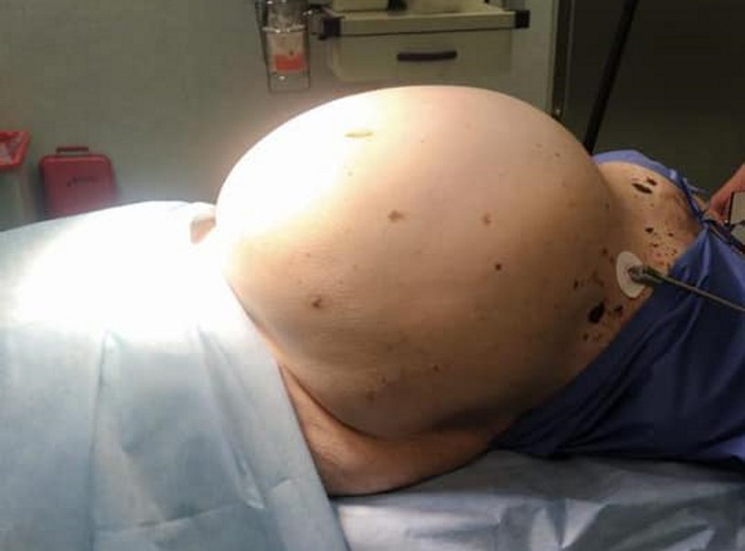 74-letnia kobieta miała brzuch wielkości brzucha kobiety w zaawansowanej ciąży /Namysłowskie Centrum Zdrowia /facebook.com