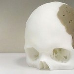 75 proc. czaszki zastąpione implantem z drukarki 3D