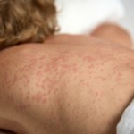 8-latka zmarła. Niebezpieczna choroba wraca