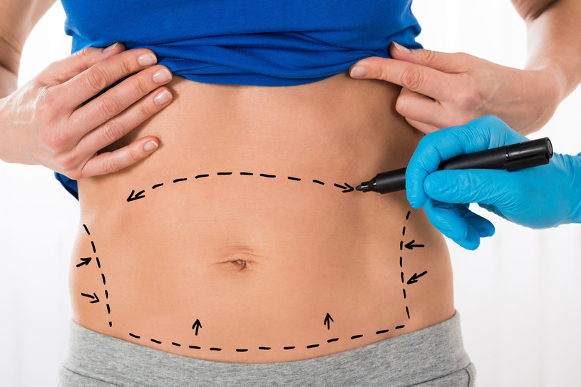 Abdominoplastyka to zabieg polegający na wycinaniu z brzucha wyłącznie nadmiaru skóry /123RF/PICSEL
