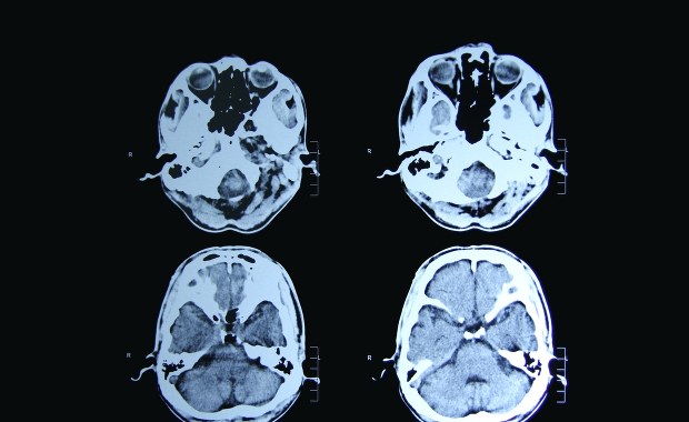 Absolutny przełom w leczeniu choroby Huntingtona