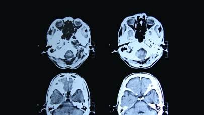 Absolutny przełom w leczeniu choroby Huntingtona