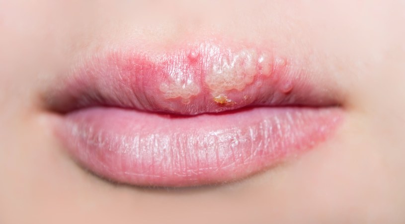 Afty i opryszczki to jedne z najczęstszych dolegliwości jamy ustnej /123RF/PICSEL