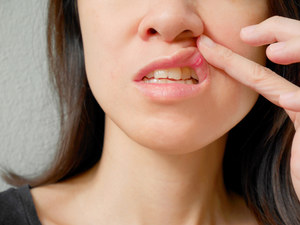 Afty - nieprzyjemne zmiany w jamie ustnej. Przyczyny, leczenie, domowe sposoby